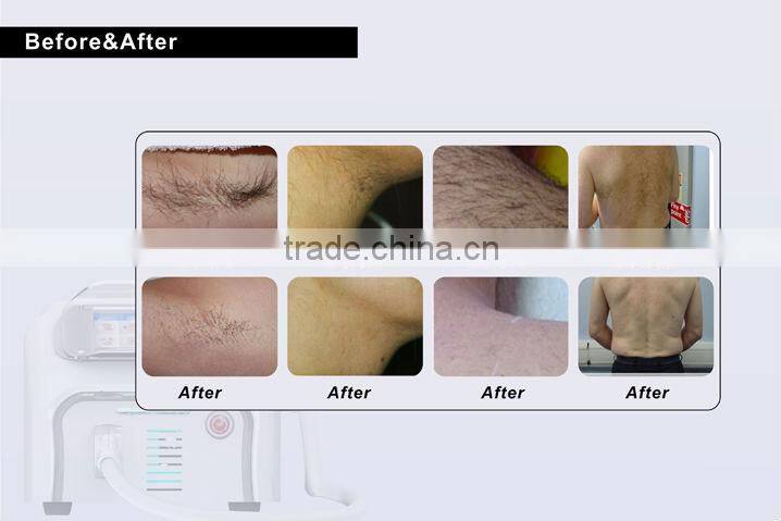 808nm Diode Laser Pernmanet Removing Hair Best Function For Hair Removal