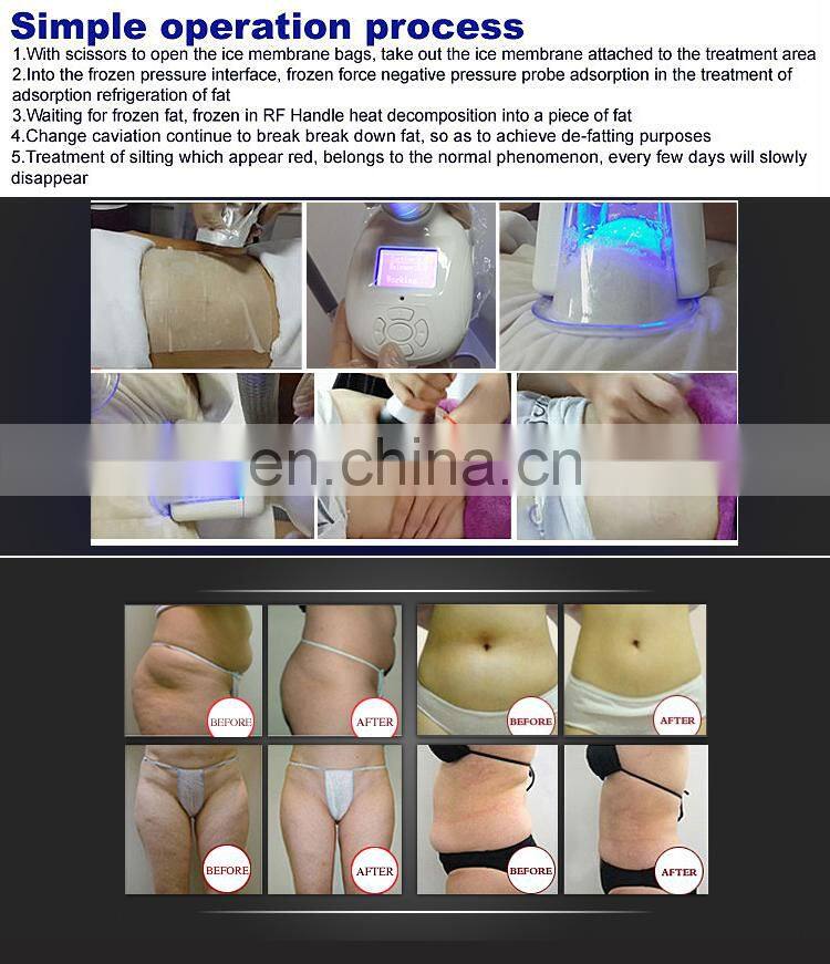 Most Sale Double cyro handles Cryolipolysis Freeze Fat slimming machine with Cavitation and RF head