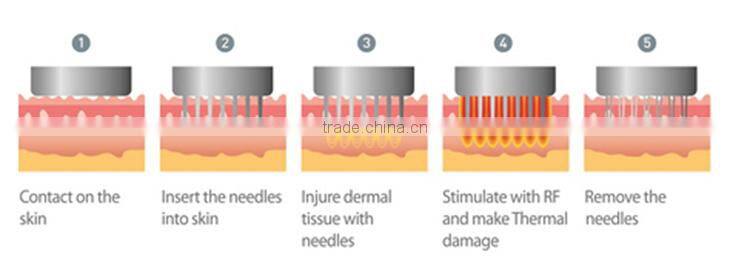 Efficient scarlet fractional microneedle rf technology wrinkles removal acne scar removal