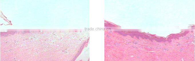 Lumsail oxygen jet peel machine for skin rejuvenation