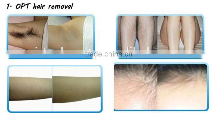 Beauty equipment multifunctional machine hair removal 2015