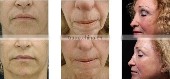 R12 facial skin tightening device monopolar rf
