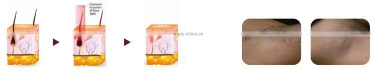 ce approved painless 1320nm 1064 nm 532nm gentle long pulse pigments tattoo removal varicose veins laser treatment q switch nd