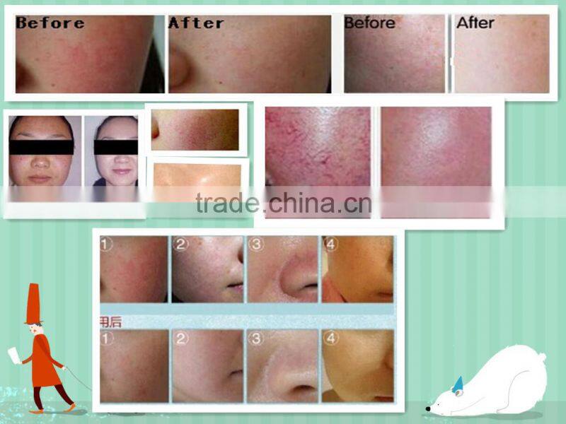 red Blood Vessels Removal Laser Beauty Equipment On Sale vein dispelling looking for agent
