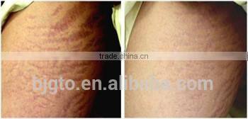 GTO 2014New GMT 540needles micro needle derma roller with blue violet head