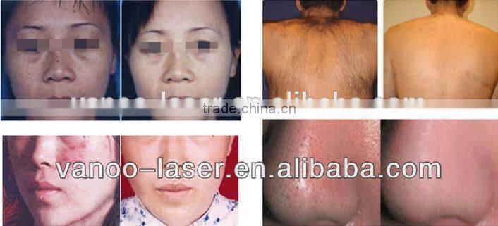 Skin care Portable ipl machine/ipl photo facial machine for home use