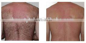 Sole distributors wanted 808 diode laser, diode laser hair removal 808, depilacion laser