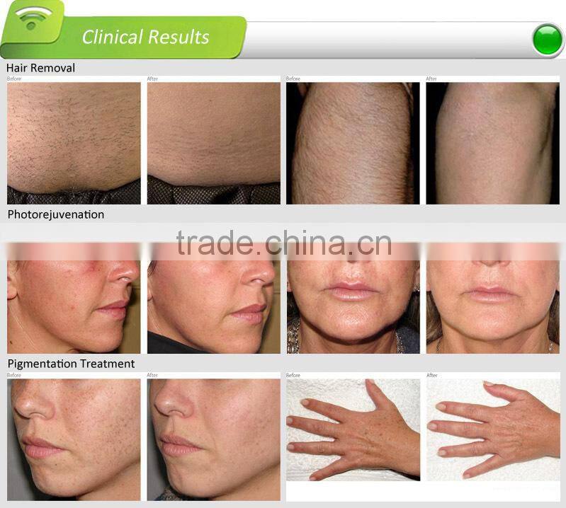 Multifunctional IPL machine,a unique IPL solution with HERAEUS(Germany)Xenon lamp,used for hair removal and photorejuvenation.