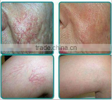 Vascular Removal Laser 980 Machine
