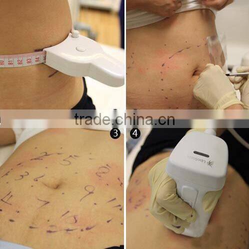 liposonic hifu Lipo Ultra SONIX / liposonic / HIFU Slimming body slimming machine
