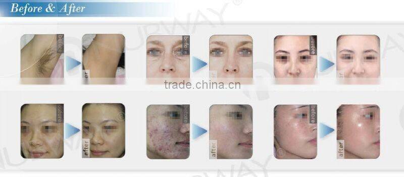 European Healthy Standard Germany Laser IPL SHR&E-light hair removal equipment&machine