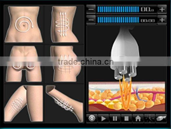 Coolipo V9 Cavitation Machine