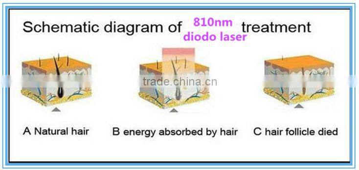Best selling products laser diodo 810nm depilation