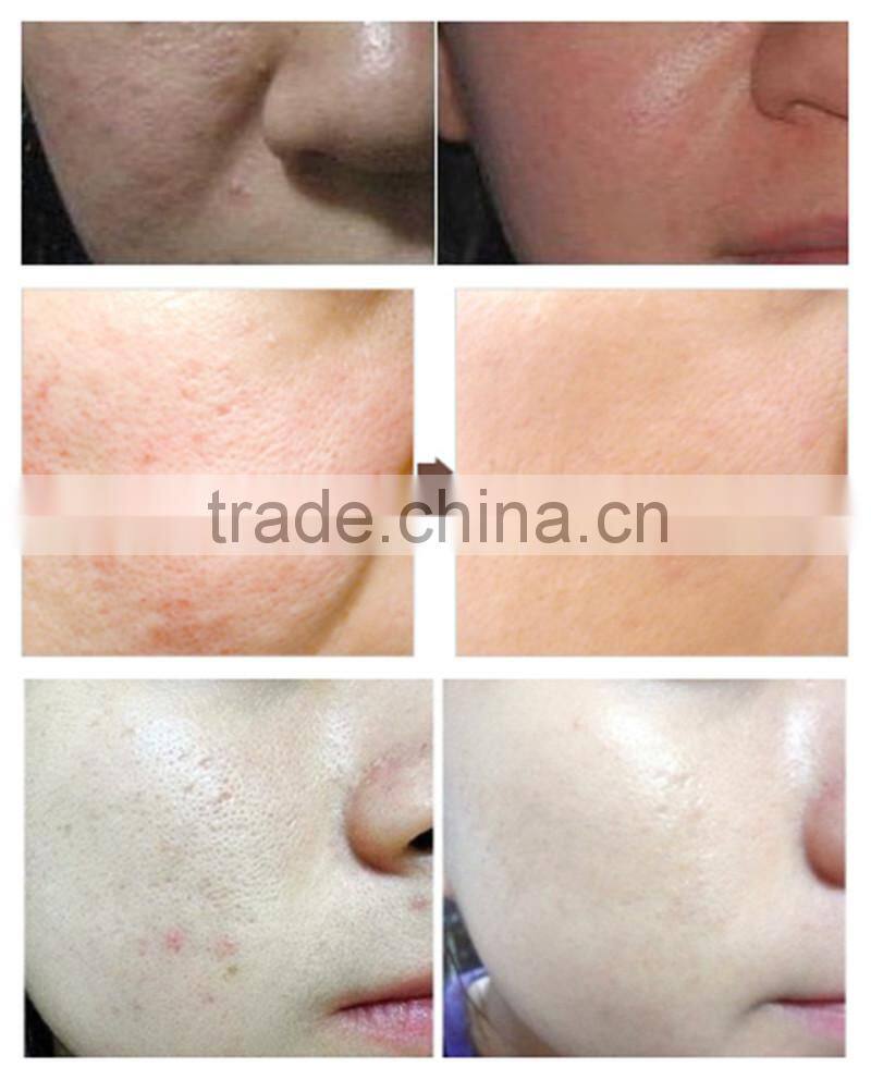 Facial led Vibration portable pdt skin care facial massager