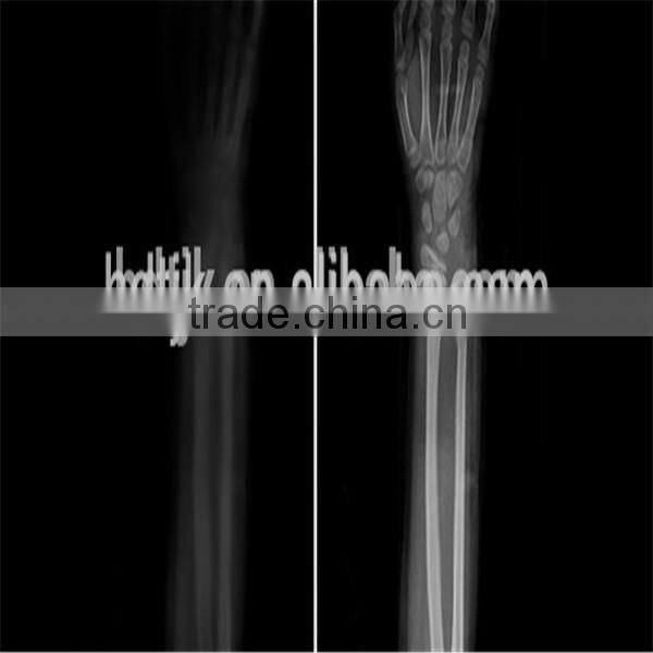with CE&FDA approved orthopedic leg splint