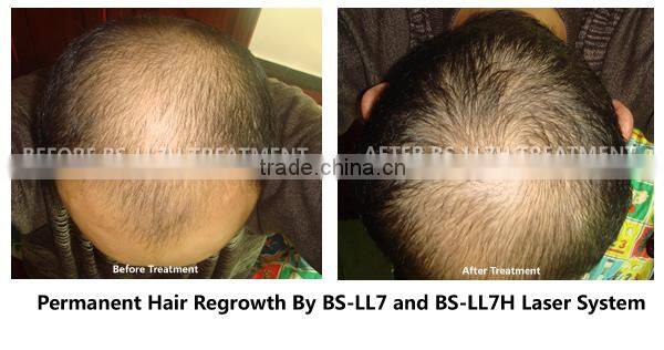 hair loss treatment machine/low level laser therapy hairloss/laser hair regrowth machines
