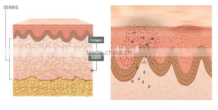 F12 Professional 1064 & 532 Q Switch ND YAG Laser Tattoo Removal / 1064 nd yag 532 ktp tattoo removal