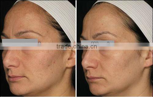 P001 Dark Skin Laser Hair Removal Long Pulse Laser with Two Treatment Heads