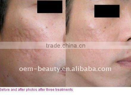 Medical Micro Needles Derma Roller L002