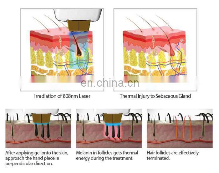 2020 hot sale painless 808nm diode laser hair removal beauty machine for clinic use
