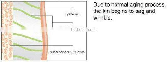 hm-rf-a100 monopolar