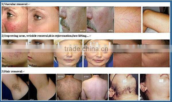2015 trending hot IPL Elight hair removal /q switched nd yag laser tattoo removal