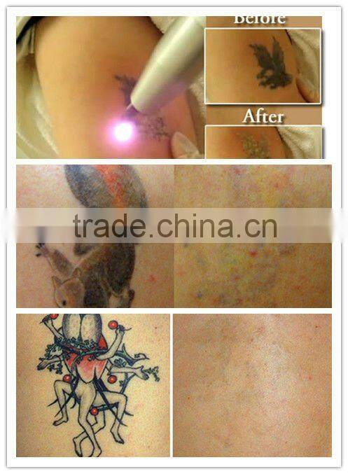 High quality--Cool Q-Switch Nd:Yag Laser for tattoo removal --Y11