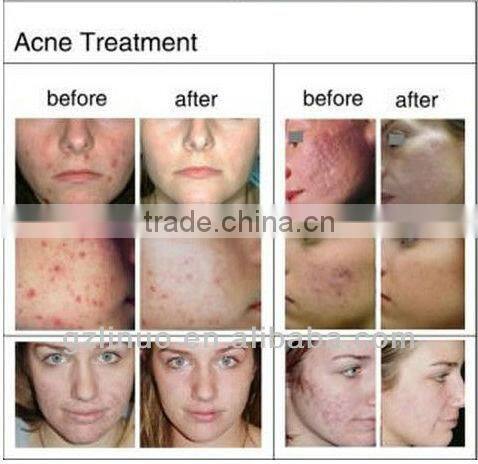 Advanced cooling system painless permanent laser shr IPL hair removal machine