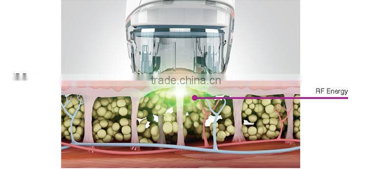 new slimming technology 2015 lipo laser newest body fat removal