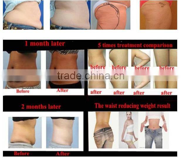 double handle work at the same time low price cryolipolysis fat freeze slimming machine