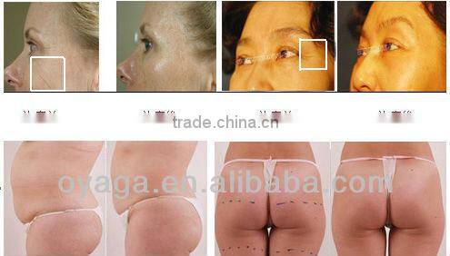(Oyaga Beauty New model) No-Needle Mesotherapy skin rejuvenation machine