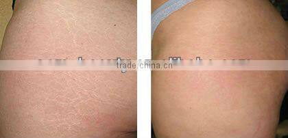 Cheapest!! microneedle roller system derma roller titanium L007