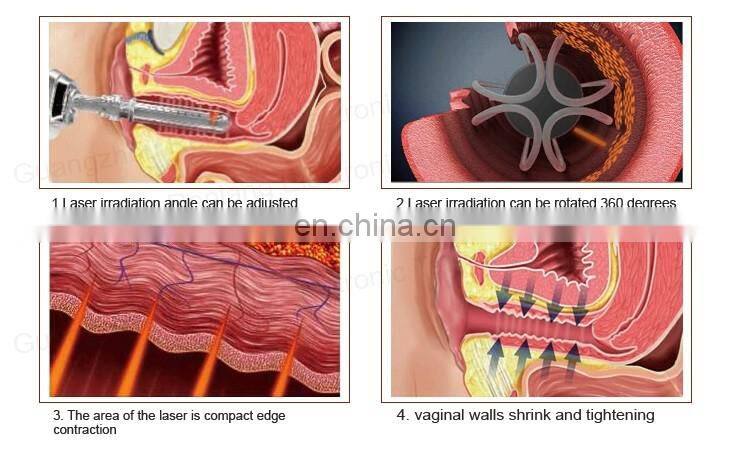 CO2 Fractional Laser Tighten Vagina Beautify Vagina Medical Beauty Equipment / fractional co2 laser machine
