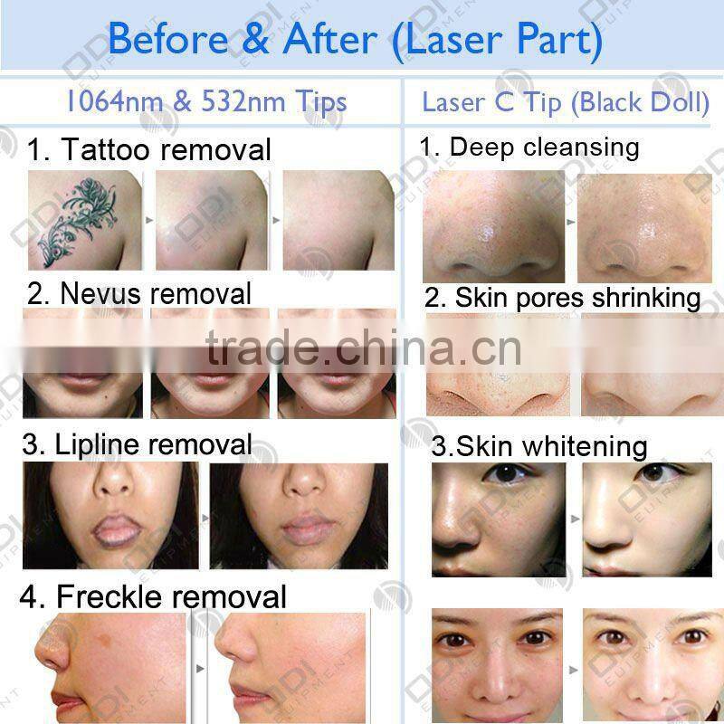 ND100 Laser Yag 200 Q Switch Nd Yag Laser Yag Tattoo Removal Machine with CE certificate