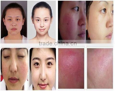 Hot selling factrory price vascular removal diode laser machine