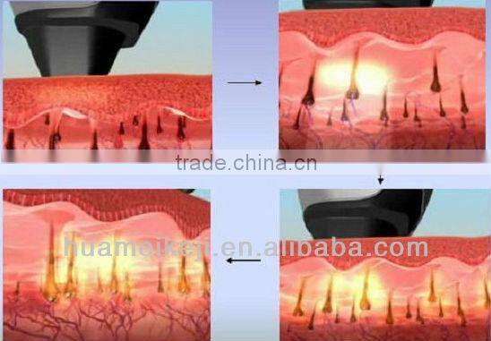 laser Hair removal in laser beauty equipment with Medical CE approval