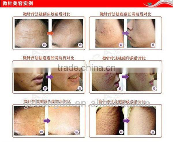 2013 LED light electric microneedle derma pen BD-WZ006