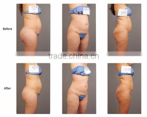Ultrashape slimming HIFU/Ultrasonix body fat loss/Ultrashape Slimming machine