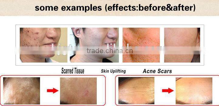 2015 new CE 540 medical grade derma roller