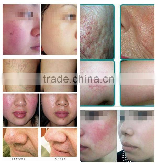 Beauty Cosmetics Laser Vascular Removal 980nm diode laser spider vein removal machine