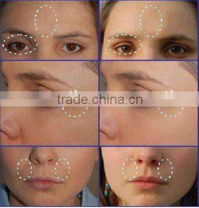 cheap price RF machine radio frequency for wrinkle removal