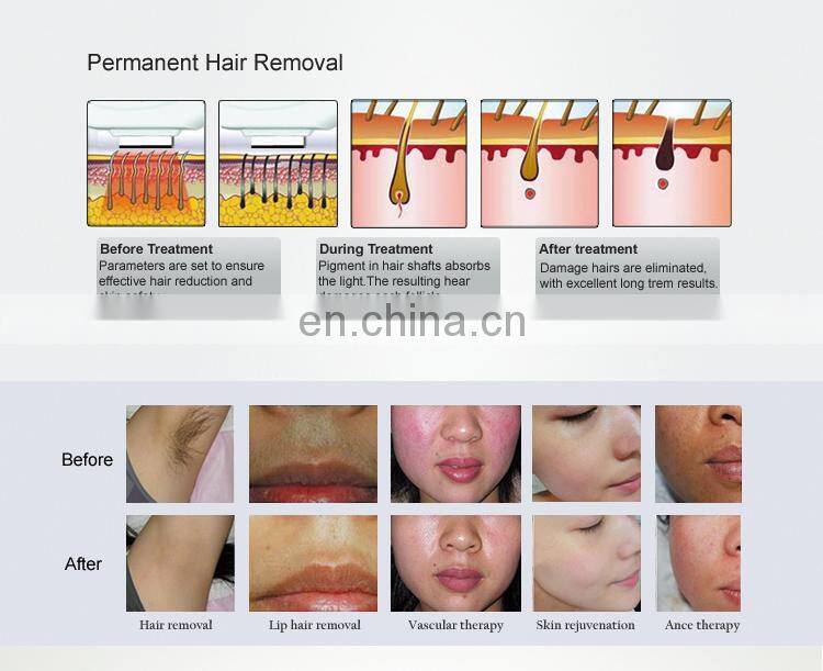 Hair removal and skin rejuvenation /desktop dual OPT / E-light laser Machine
