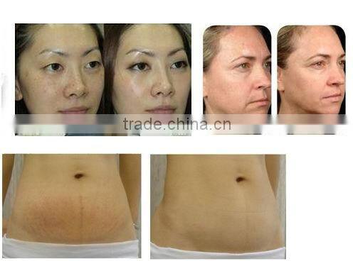 Hot new product for 2014 thermal skin tightening machine