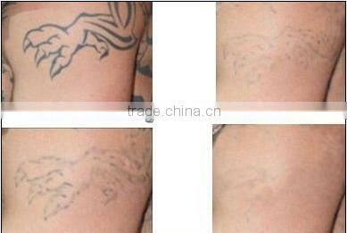 Fast effective on all color tattoo removal ND YAG q switched Laser machine with OEM service D006