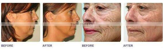 2015 factory promotion!!!!!!! Permanent opt hair removal ipl shr ssr machine