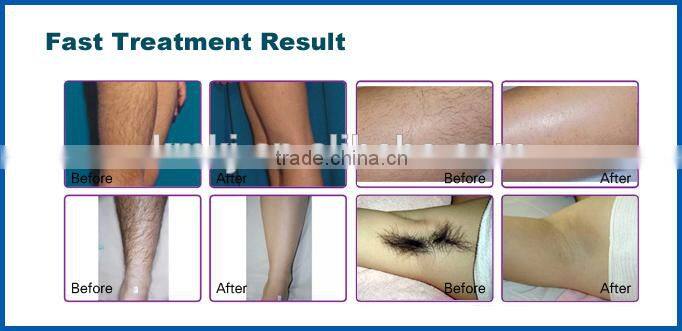 Hair Removal 808 Diode laser/Advanced Germany technology portable 808 diode laser