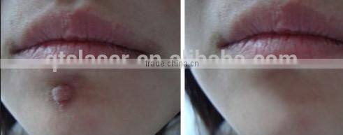 permanent laser tattoo/pigmentation corrector acne removal machine Q switch nd yag laser