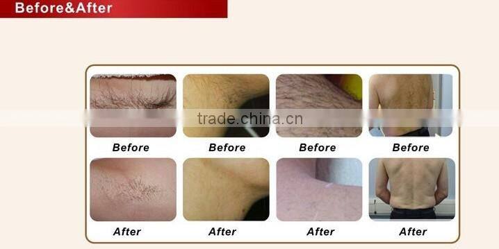 handheld 808nm diode laser machine for hair removal