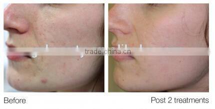 WF-15 Jet peel water oxygen skin rejuvenation machine