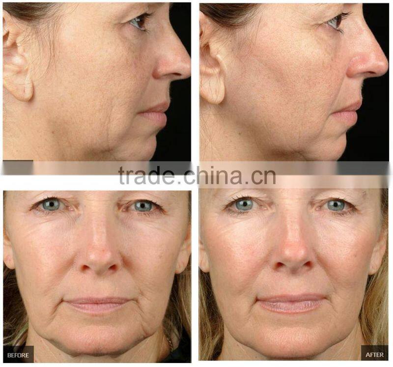 skin treatment 5mhz radio frequenc micro cell fraction rf skin lifting machine